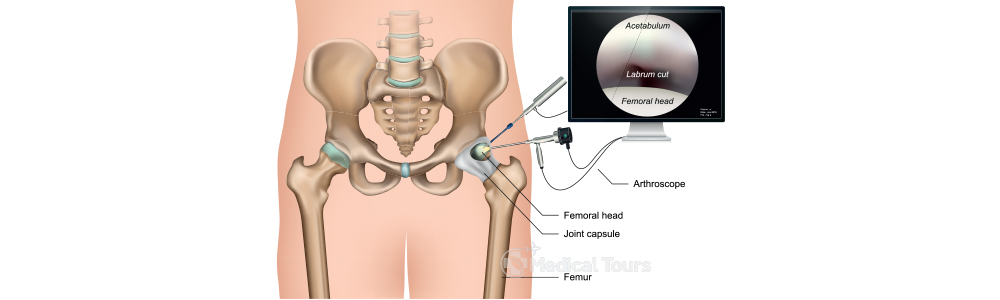 Hip Arthroscopy
